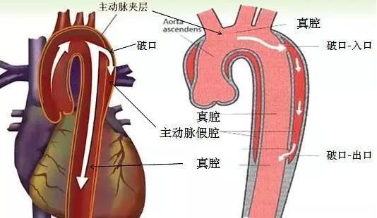 背痛一天后突然去世，医生都措手不及，啥病这么恐怖?