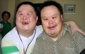 这种因为染色体畸变造成疾病的孩子几乎长相一