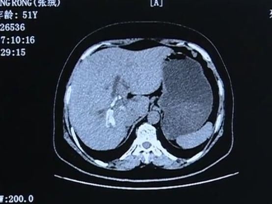 女子身体内取出数百块石头，你有这习惯吗?赶紧自查