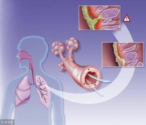 慢性支气管炎的临床症状中最突出的表现是什么