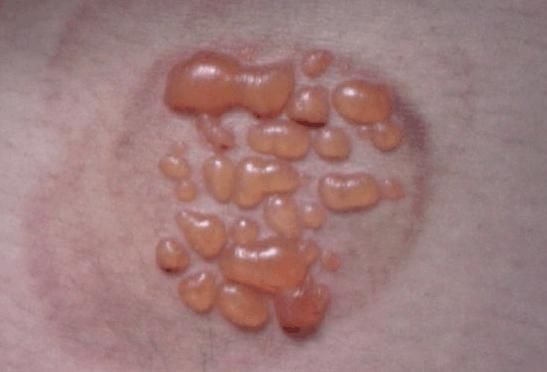 拔火罐时拔出水泡,说明了什么?听听老中医怎么说!_【快资讯】