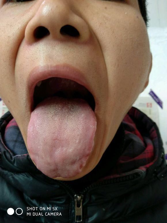 珍贵舌诊:津液不足、肝郁气滞、脾肾阳虚的舌