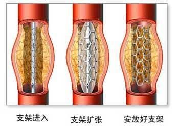 心脏病放完支架后患无穷？究竟支架有哪些副作用？我们都错了！