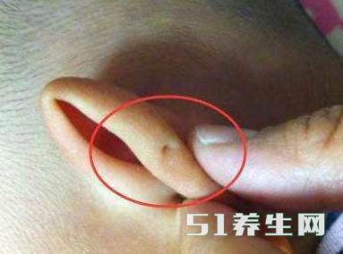 孩子耳朵上的小孔是富贵孔?实际是这个,跟富