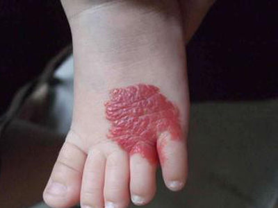 小儿身上长红痣,是血管瘤?小儿4类常见血管瘤