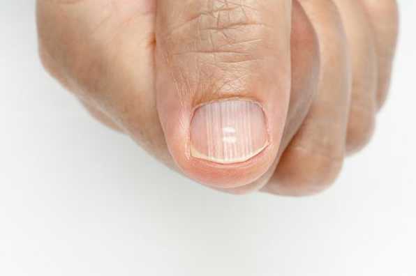 看指甲知健康,用指甲给自己做个体检