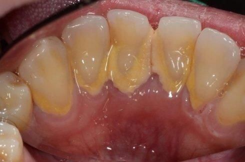 快速消除牙结石的小偏方,在家抽出5分钟就能搞