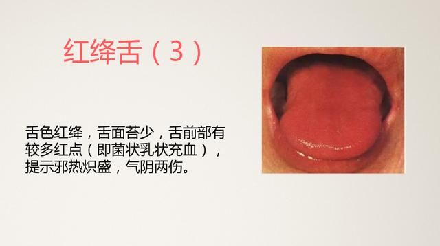 《中医舌诊》,23张高清案例图,一看就懂,记住你