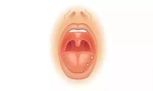 嘴巴里长了口腔溃疡,这些食物不要吃!