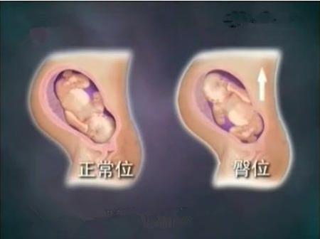 胎儿头位和臀位有什么区别 准妈妈侧卧睡可以