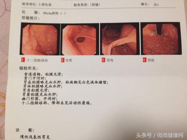 “对付”老胃病，给你3个食疗方，好了不再复发