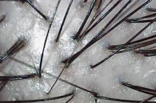 脱发严重，教你如何应对毛孔闭合、毛囊闭合