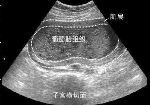 怀孕三个月肚子奇大,以为是多胞胎,医生怒斥孕