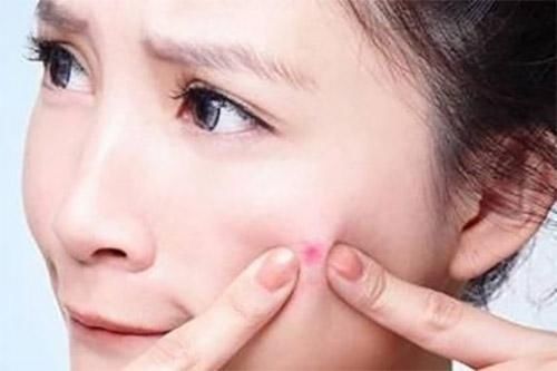 皮肤变油黑头痘痘不断,才知皮肤下都是螨虫,杀