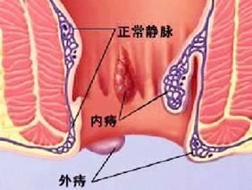 再也不敢动刀治痔疮，这个方法，再用毛巾热敷，痔疮竟然就消失了