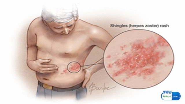 小康药说:更昔洛韦胶囊对皮肤疱疹有哪些作用