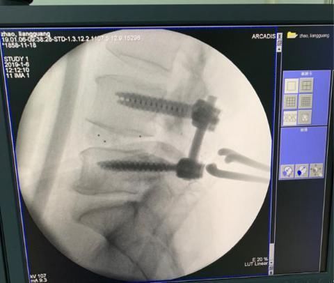 腰椎间盘突出手术费用