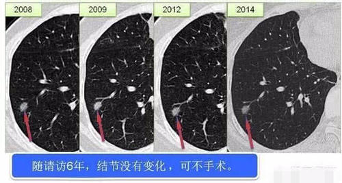 肺部CT结果为未见异常。可以多久时间不用