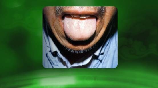 专家教您从舌苔辨体质,从舌苔断病症,从舌苔看