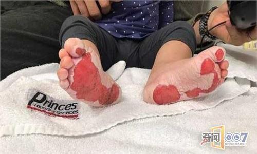 18月大女婴公园学步双脚惊现大片血泡,元凶竟