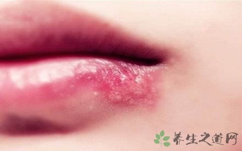 口角生疮吃什么药