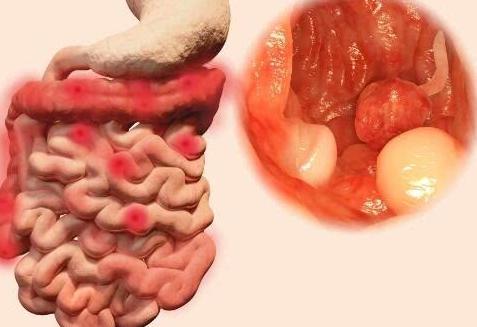 体若出现4类情况,一定要尽快筛查,警惕肠癌,别