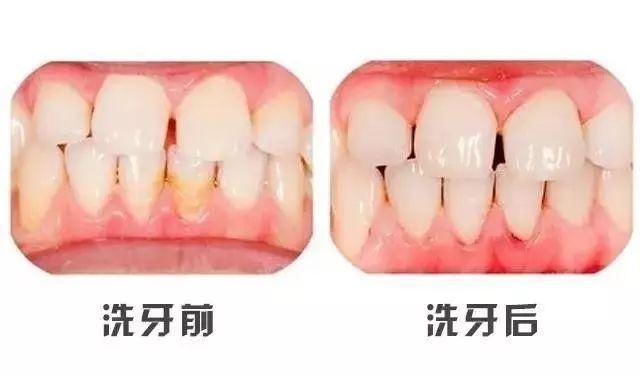 洗牙和牙齿美白有区别吗?看完你就明白了!