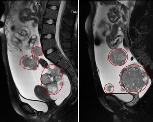 ，让在场医生十分揪心！术中冰冻结果显示，为右卵巢生殖细胞恶性肿瘤！