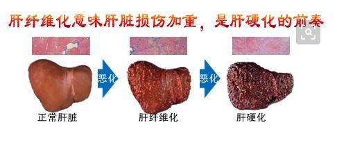 济南协和肝病医院解惑,肝硬化消化性溃烂有哪