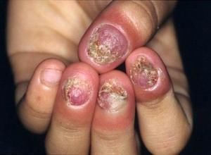 解读:灰指甲康复后如何避免再次感染?