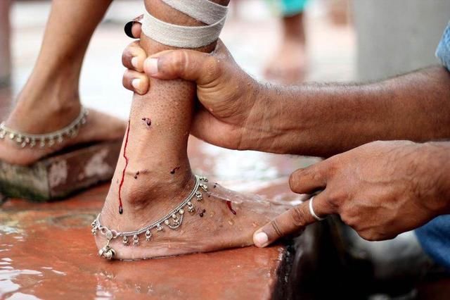 每年死于此病的人超100万,小腿出现1个信号,要