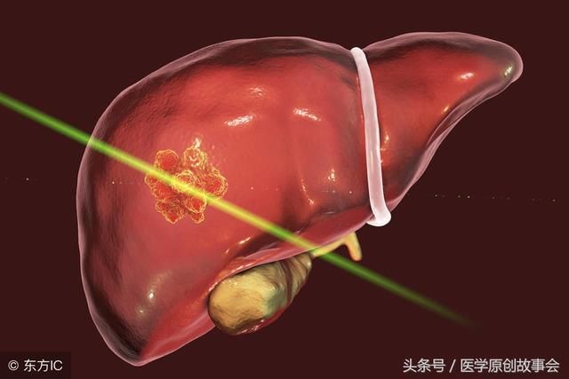 肝上长了东西一定是肝癌吗，医生说有这四种可能！