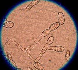 细菌性阴道炎和真菌感染有哪些区别?