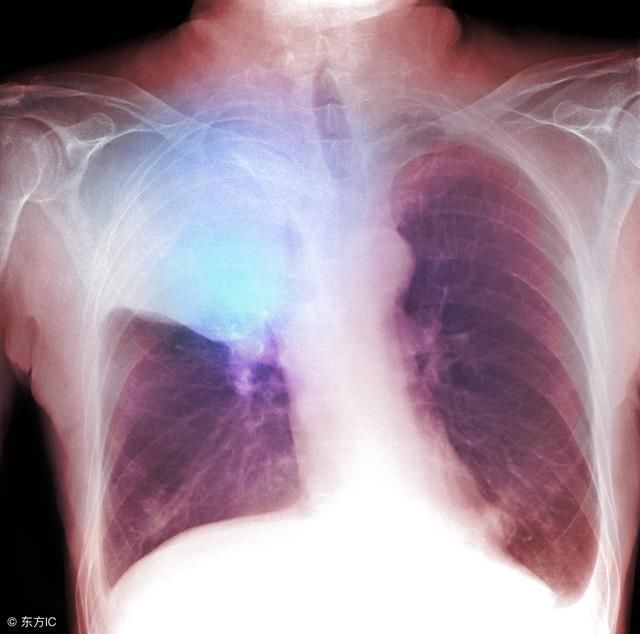肺癌复发症状是怎样的?术后如何休养