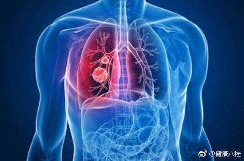 别忽视肺小结节 它是肺癌的"爸爸"_【今日爆点】