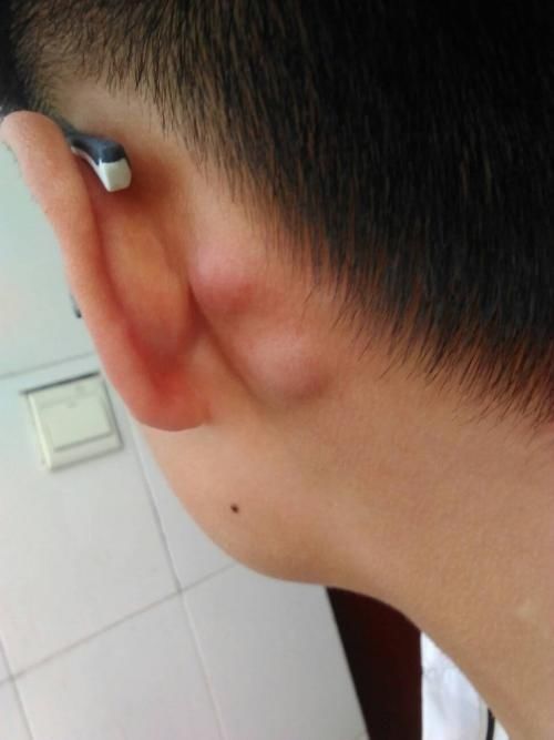 耳朵后面长了个硬包是怎么回事?专家说:要当心