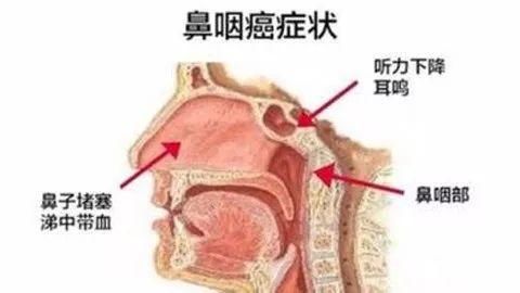 “家庭癌”高发，莫非癌症真的可以传染?