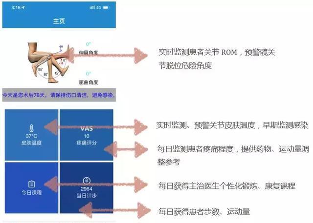 膝关节置换术费用