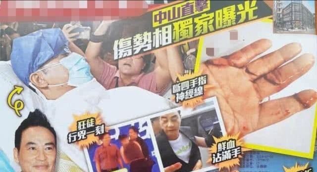 触目惊心!任达华右手四根手指神经被割断,食指几乎断掉