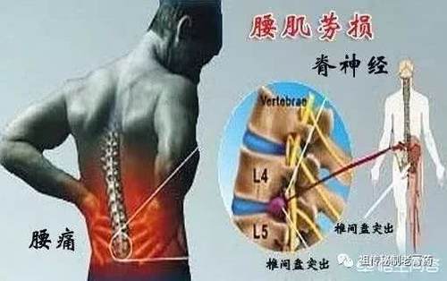 什么运动适合腰椎 t01a1b62da893476bdc.jpg