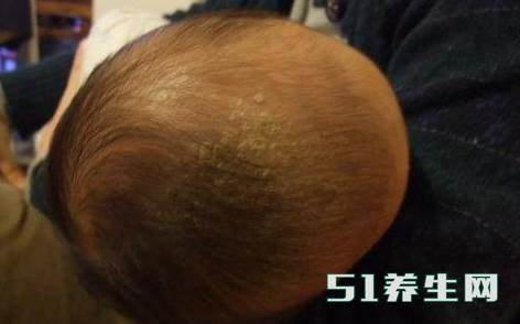 4个月宝宝持续高烧不退,医生看到宝宝的头以后