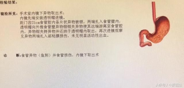 老太吃鱼脸被扎主动脉下支架需要十几万，4科室会诊后胃镜下取出