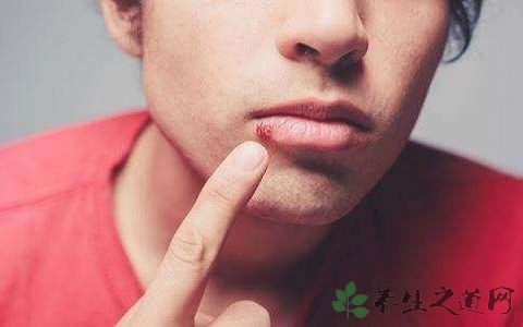 口角生疮吃什么药