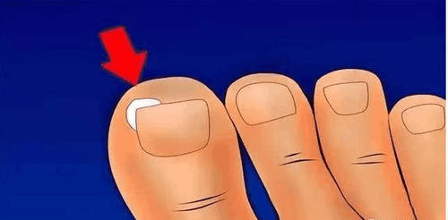 指甲长进肉里怎么办?1招让你轻松解决甲沟炎
