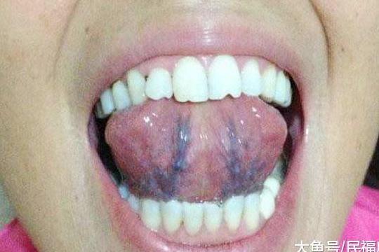 身体出现问题, 舌下青筋可能会发出3种信号
