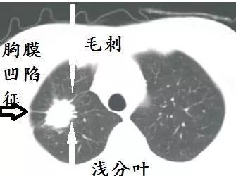 肺CT也会装酷:如何从CT上看出肺癌的病理类型?