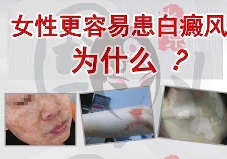【转载】女性白癜风在患者饮食上需要注意哪些