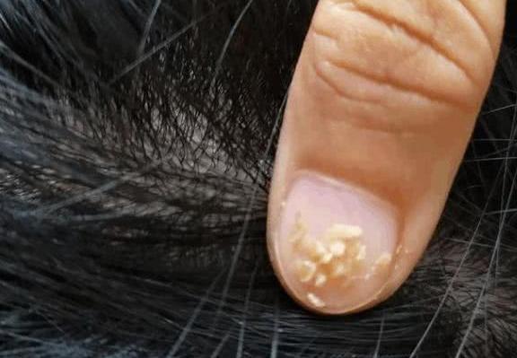 医生: 头上螨虫的天敌竟是这3物, 多洗, 头发不