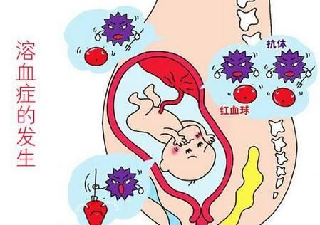 怀孕后什么是ABO溶血,3种孕妇备孕需做溶血