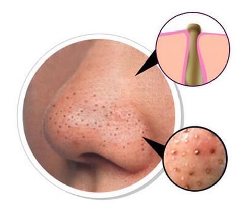 鼻子黑头别用手挤，越挤黑头越多，教你几招，和“草莓鼻”说拜拜